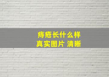 痔疮长什么样真实图片 清晰